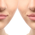Fillers botox Alingsås